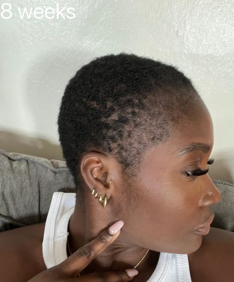 Traction Alopecia Regrowth, Traction Alopecia Hairstyles, Alopecia Hairstyles Black Women, Afro Hair Salon, Scarring Alopecia, Hair Transplant Women, Alopecia Hairstyles, Forehead Hair, Traction Alopecia