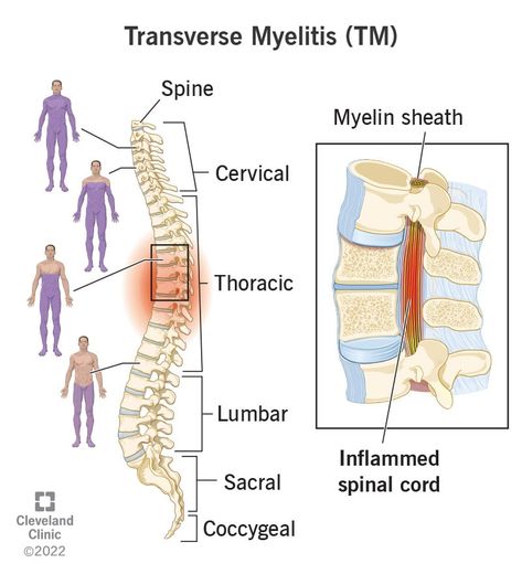 Transverse Myelitis, Spinal Fluid, Sjogrens Syndrome, Muscle Weakness, Medical Anatomy, Cleveland Clinic, Neurological Disorders, Autoimmune Disorder, Spinal Cord