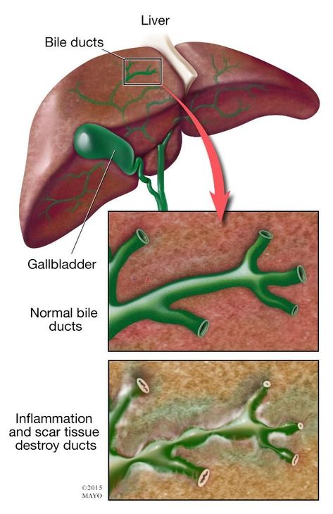 Liver Primary Biliary Cholangitis, Ma Notes, Musculoskeletal Pain, Liver Failure, Bile Duct, Inflammation Causes, Bacterial Infection, Scar Tissue, The Liver