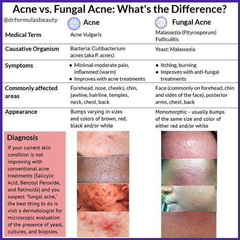 Skincare Science, Fungal Acne, Forehead Acne, Acne Vulgaris, Love Oil, Medical Terms, September 16, Skin Care Treatments, Wellness Tips