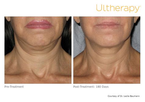 Ultherapy Before And After, Facelift Without Surgery, Double Chin Removal, Dermatologist Doctor, Sagging Neck, Non Surgical Facelift, Facial Plastic Surgery, Cosmetic Dermatology, Neck Lift