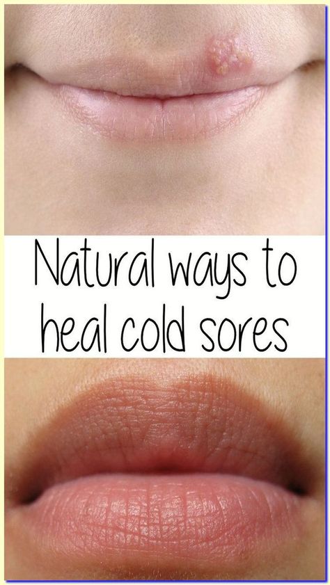 WHAT SHE SPREADS ON HER SKIN, EVERYONE HAS AT HOME, BUT NOBODY USES IT! Common Cold Remedies, Get Rid Of Cold, Ways To Heal, Cold Sores, Healthy Facts, Allergy Remedies, Canker Sore, Cold Sores Remedies, Cold Symptoms