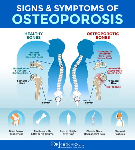 Osteoporosis: Symptoms, Causes and Natural Support Strategies Osteoporosis Symptoms, Magnesium Deficiency Symptoms, Femur Bone, Hip Fracture, Magnesium Deficiency, Bone Loss, Uric Acid, Health Guide, Bone Density