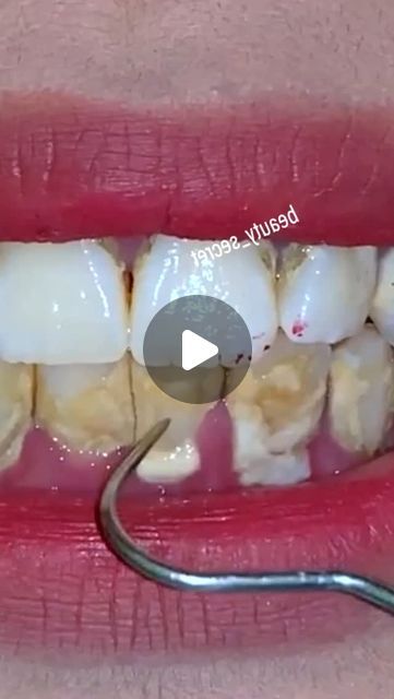 Healthy Tips on Instagram: "Teeth Whitening Remedy #teethwhitening #remedy" Diy Teeth Cleaning At Home, Braces Colors For White Teeth, How To Remove Plaque From Teeth At Home, Baking Soda And Peroxide Teeth, How To Whiten Teeth At Home, Teeth Cleaning Videos, Tartar Removal From Teeth, How To Whiten Teeth, Yellow Teeth Remedy