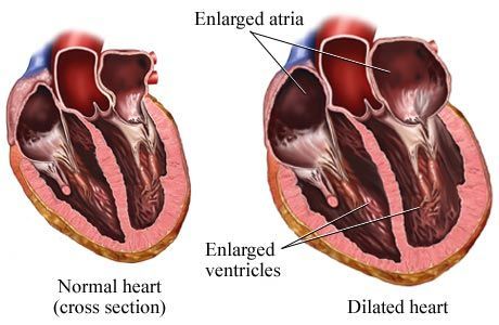 Enlarged Heart Symptoms, Body Moodboard, Enlarged Heart, Heart Valves, Normal Heart, Medical Procedures, Heart Healthy Diet, Gene Therapy, Chewing Gum