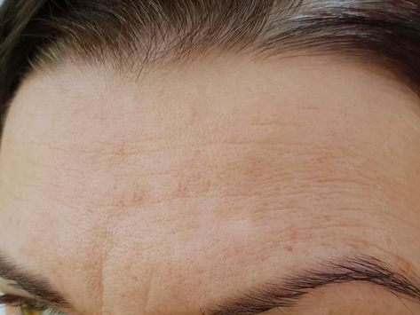 Forehead Wrinkles Remedies, Remove Forehead Wrinkles, Get Rid Of Forehead Wrinkles, Facial Wrinkles, Forehead Wrinkles, Exfoliating Cleanser, Chemical Peel, Acne Marks, Moisturizer With Spf