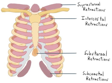 Retraction location - respiratory distress Retractions Respiratory, Pediatric Nursing Respiratory, Nursing School Life, Respiratory Distress, Cna Nurse, Care Management, Nursing Care Plan, Neonatal Nurse, Respiratory Care