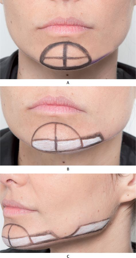 Facial Veins, Filler Injection, Face Plastic Surgery, Attractive Face, Face Fillers, Marionette Lines, Botulinum Toxin, Lower Third, Facial Fillers