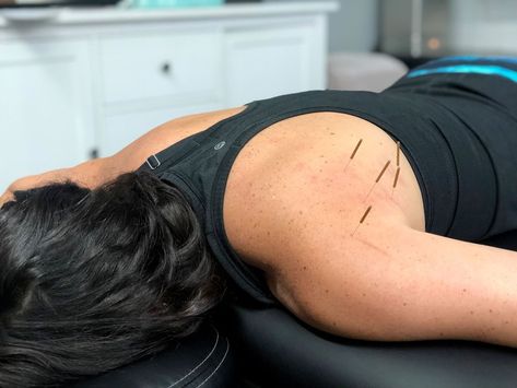 Lagree Microformer, Needling Therapy, Dry Needling Therapy Physical Therapist, Dry Needling Therapy, Gymnastics Gym, Dry Needling, Kids Gymnastics, Why I Run, Runners High