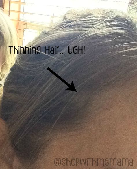 Why is my hair thinning? Hair Thinning At Crown, Thinning Hair Remedies, Hair Thinning, Hair Remedies, Shop With Me, Thinning Hair, My Hair, Hair Hair, Hair Styles