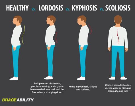 Find out what spinal curvature disorder you have: lordosis, kyphosis, scoliosis. | BraceAbility Intercostal Muscles, Lumbar Lordosis, Posture Improvement, Inversion Therapy, Pregnancy Pain, Forward Head Posture, Posture Exercises, Mohammed Ali, Spine Health