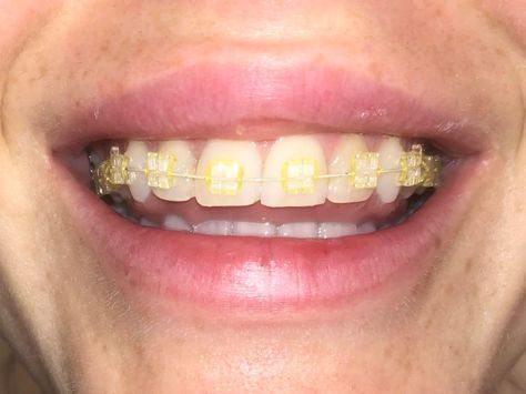 Do braces make your teeth yellow? Read on to know how to stop it.. Ceramic Braces Color Bands, Clear Braces With Color Bands, Hot Pink Braces, Yellow Teeth Remedy, Teeth After Braces, Get Rid Of Yellow Teeth, Teeth Yellow, Pink Braces, Teeth With Braces