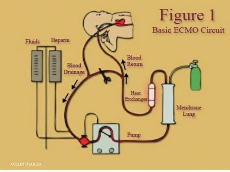 ECMO- An Extracorporeal Membrane Oxygenation (ECMO) machine is a medical device that performs this task. In fact, it is very similar to a heart-lung machine that is used to continue the supply of blood and oxygen while the heart is stopped, such as during open heart surgery. ECMO therapy, however, is intended for patients whose heart and lungs cannot normally function on their own. Ecmo Machine, Paramedic School, Ob Nursing, Open Heart Surgery, Med Tech, Heart And Lungs, Healing Touch, Heart Surgery, Laboratory Science