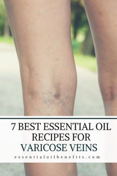 Varicose Veins Essential Oils, Varicose Vein Remedy, Calendula Benefits, Fruit Health Benefits, List Of Essential Oils, Lemon Benefits, Essential Oils For Skin, Essential Oil Benefits, Essential Oils Recipes