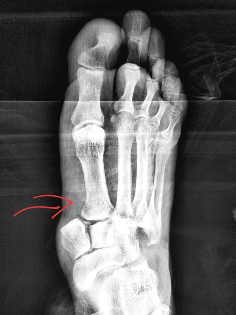 #Foot #xray: fracture dislocation (homolateral #Lisfranc) after #motorcycle accident. #radiologist #radiology #pain #trauma #injury Leg Fracture Snap, Leg Xray, Accident Motorcycle, Fractured Leg, Leg Broken, Cash Indian, Money Images Cash Indian, Chill Life, Radiology Student