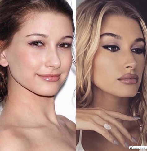 Celebrity Plastic Surgery Cheek Fillers, Celebrity Plastic Surgery, Celebrity Skin, Makeup Tutorial Eyeshadow, Nose Shapes, Celebrities Before And After, Seasonal Color Analysis, Nose Job, Lip Fillers