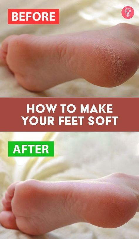 Soften Feet Overnight, Soft Feet Remedy, Cracked Feet Remedies, Dry Feet Remedies, Cracked Heel Remedies, Diy Foot Soak, Dry Cracked Heels, Foot Soak, Cracked Heels