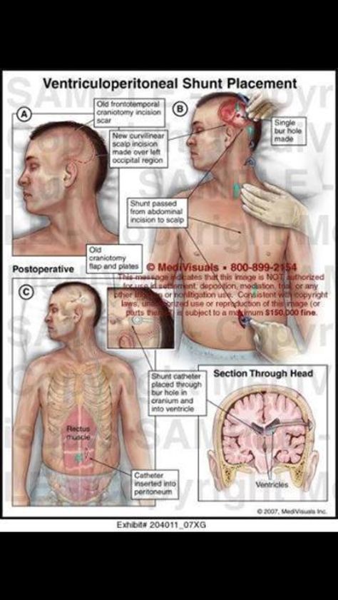 VP shunt Vp Shunt, Brain Surgery Recovery, Intracranial Pressure, Neurological System, Brain Surgeon, Chiari Malformation, Surgical Nursing, Cerebrospinal Fluid, Brain Surgery