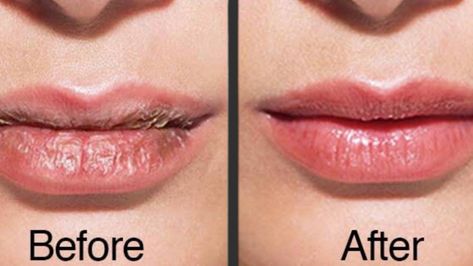 How To Heal Dry And Cracked Lips | Home remedies for dry lips in winter | MS Health and Beauty #drylips #drylipsremedy #drylipstreatment #dryandcrackedlips ... Dry Cracked Lips Remedy, Cracked Lips Remedy, Remedies For Dry Lips, Dry Lips Remedy, Zit Remedy, Remedies For Dark Lips, Dry Cracked Lips, Winter Lips, Wax Strips