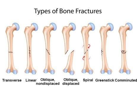 Types Of Fractures, Nerdy Nurse, Osteogenesis Imperfecta, Types Of Bones, Useful Skills, Radiology Student, Bone Grafting, Nclex Review, Bone Fracture