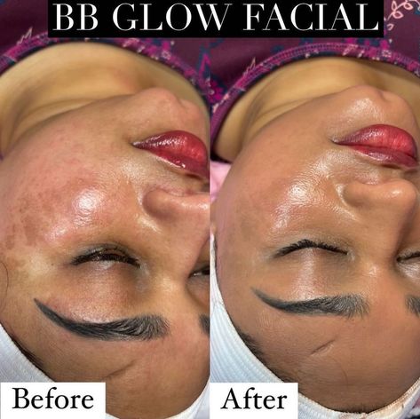 Bb Glow Facial Before And After, Bb Glow Before And After, Bb Glow Facial, Permanent Foundation, Facial Before And After, Bb Glow, Semi Permanent, Your Skin, Foundation