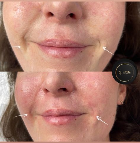 Benefits of Filling Nasolabial fold with Filler:💉 🌸Volume Restoration: As we age, we lose volume in our cheeks and mid-face, which contributes to the deepening of nasolabial folds. Fillers can restore this volume, providing a lifted and rejuvenated look. 🌸Improved Facial Balance: By filling in nasolabial folds, you can achieve more balanced facial features. This can improve the overall symmetry of the face and enhance other features such as the lips and cheekbones. 🌸Minimal Downtime 🌸Immed... Nasolabial Folds, Facial Features, The Face, Facial, Benefits, Lips, Quick Saves