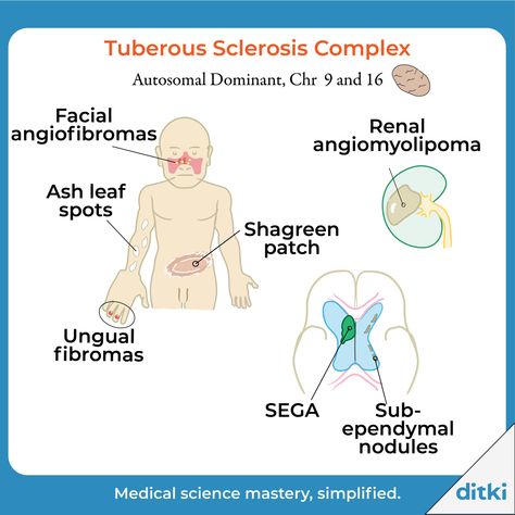 What are some other manifestations of this disorder? Answers: https://ditki.com/course/pathology/glossary/pathophysiologic-disorder/familial-tumor-syndromes-tuberous-sclerosis #ditki #usmle #meded #medschool #medstudent #highered #mededonline #pathology #tuberoussclerosis #geneticdisorder #neurology #pance #physicianassistant #osteopath #allopath #medicine #science #healthscience #nurse #premed #mcat #mbbs Neuroendocrine Tumor, Nicotinic And Muscarinic Receptors, Tuberous Sclerosis, Insufficient Glandular Tissue, Adenosine Triphosphate, Excitatory And Inhibitory Neurotransmitters, Genetic Disorders, Pre Med, Physician Assistant