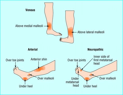 Types and typical sites of leg ulcer Wound Nurse, Wound Management, Wound Care Nurse, Wound Care Nursing, Doppler Ultrasound, Leg Ulcers, Nursing Assessment, Community Nursing, Nursing School Essential