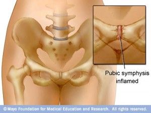 General Pubic Symphysis Dysfunction: The pubic symphysis is a very stiff, synovial joint that exists midline of the pelvis. It moves on average, about 2 mm but becomes dysfunctional if it moves more or less. The cause for pubic symphysis dysfunction can be attributed to hormonal changes, lengthening and weakening of pelvic ligaments, thoracolumbar fascia … Medical Assistant Student, Pelvic Girdle, Pelvic Bone, Mom Bod, Psoas Muscle, Fit Mama, Joints Pain Relief, Pelvic Pain, Baby Massage