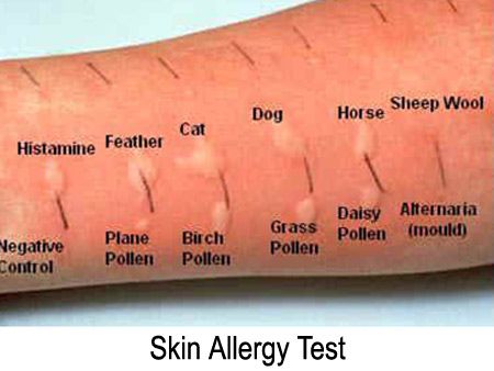 Allergy Testing Skin, Emt Study, Rauch Fotografie, Skin Allergy, Allergy Awareness, Allergy Asthma, Allergy Testing, Mosquito Bite, Skin Allergies