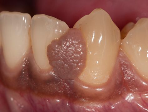 Periapical Granuloma is a soft, round lesion at the apical end of an infected tooth consisting of Granulation tissue, while a periapical cyst is a well-rounded, epithelium-lined sac that can be filled with clear fluid, pus or blood. Periapical granuloma if left untreated for a long can turn into a periapical cyst. What is a […] The post Difference Between Periapical Granuloma and Cyst first appeared on Difference Between. Stratified Squamous Epithelium, Granulation Tissue, Maxillary Sinus, Tooth Extraction, Things Under A Microscope, Root Canal, Chronic Inflammation, Tooth Decay, Cavities