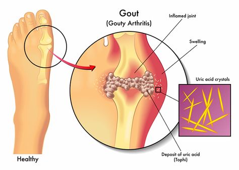 If you’ve ever woken up with severe pain in the base of your big toe, instep, or ankle, you may have had a bout of gout. In foot as well as hand and wrist areas, gout is unpleasant but can be short-lived if treated correctly. Kwas Moczowy, Uric Acid, Natural Drinks, Joints Pain Relief, Acupuncture Points, Essential Oil Recipes, Doterra, Pain Relief, Just In Case