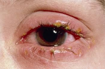 Pink Eye Infection, Pink Eye Relief, Pink Eye Remedy How To Get Rid Of, Conjuctivita Eye, Eye Infection Symptoms, Pink Eye Remedy, Crusty Eyes, Eye Stye Remedies, Pinkeye Remedies