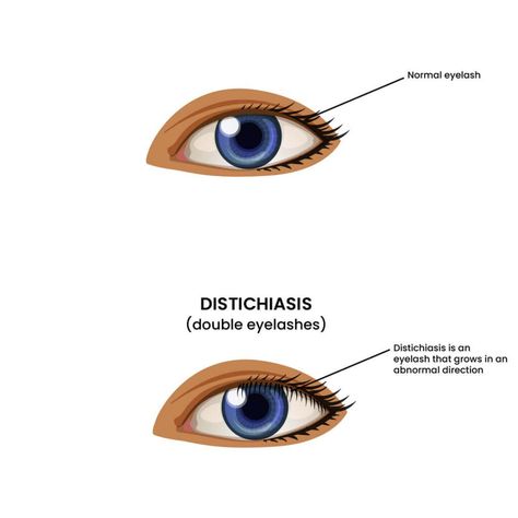 Double Eyelashes, Swollen Eyelid, Steven Johnson Syndrome, Droopy Eyelids, Grow Lashes, Lymph Fluid, Genetic Mutation, Genetic Disorders, Eye Surgery