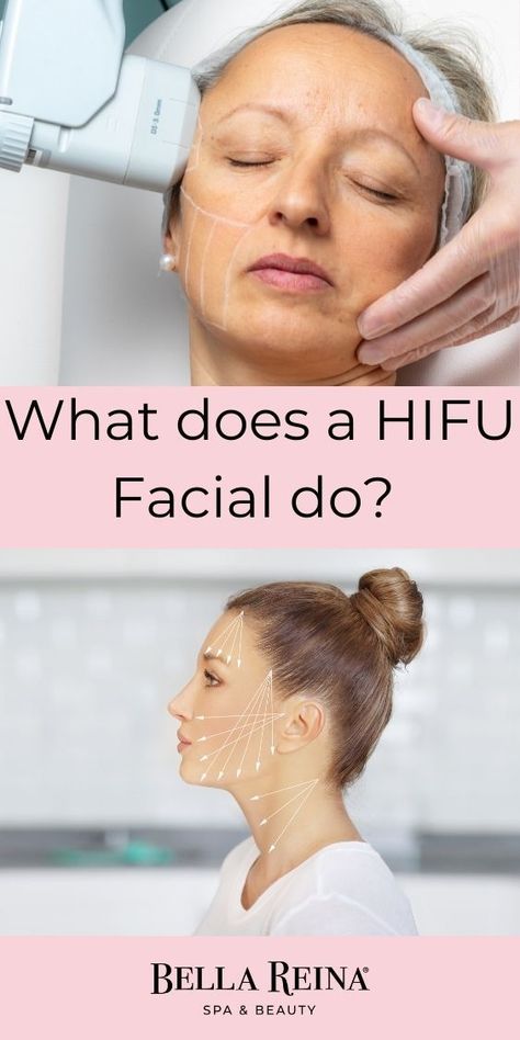 Ultrasound Facial Skin Treatments, Hifu Facelift Before And After, Hifu Facelift, Hifu Facial, Spa Facials, Facelift Before And After, Cheek Implants, Facial Aging, Non Surgical Facelift