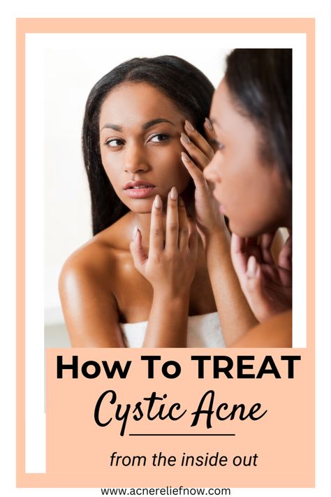 Natural ways to treat hormonal acne. How to manage hormonal acne. Learn what causes hormonal acne, ways to treat hormonal acne at home, hormonal acne tips, hormonal acne diet plan and treating hormonal acne naturally. Click the pin to get rid of hormonal acne for good. Acne Prone Skin Care Products, Skincare Acne Prone Skin, Acne Diet Plan, Skincare Routine Natural, Treatments For Acne, Hormonal Acne Diet, Comedonal Acne, Treating Cystic Acne, Acne Hyperpigmentation