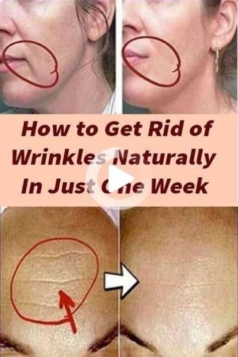 >>CHECK THIS OUT<< How to Prevent Wrinkles: Natural Anti-Aging Wrinkle Remedies Regular Skin Care Routine, Get Rid Of Wrinkles, Wrinkle Remedies, Wrinkle Free Skin, Skin Lightener, Best Skin Care Routine, Anti Aging Wrinkles, Saggy Skin, Natural Anti Aging