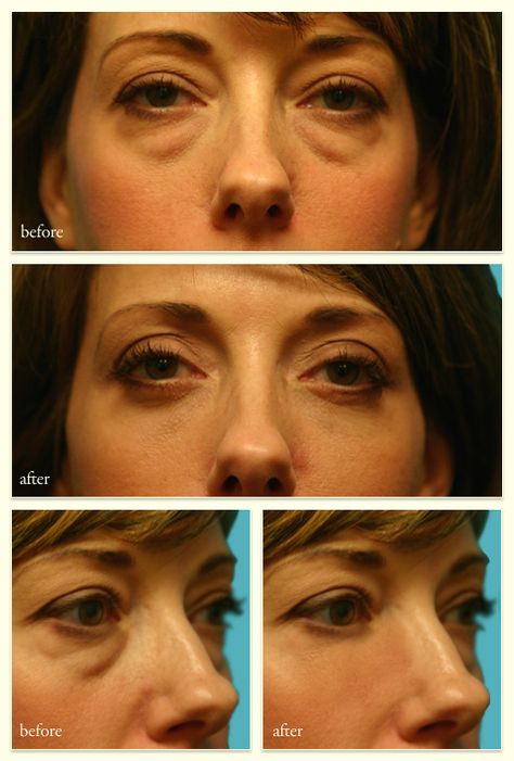 Blephoraplasty Before And After, Blephoraplasty Surgery, Upper Blephoraplasty Before And After, Lower Blephoraplasty Before And After, Droopy Eye Makeup, Bulbous Tip Rhinoplasty Before After, Belfaroplasty Surgery, Rhinoplasty Swelling Progression, Facelift Without Surgery