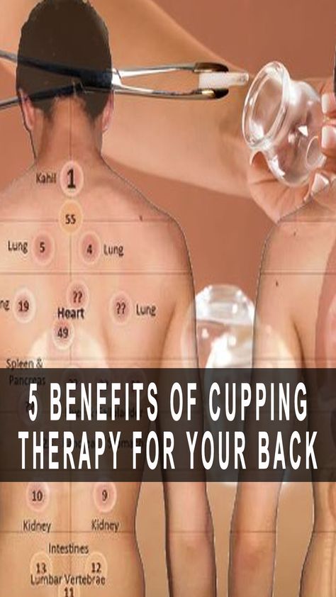 5 Benefits Of Cupping Therapy For Your Back Cupping Points Chart, Dry Cupping Therapy Chart, Cupping Therapy Chart Trigger Points, Cupping Placement Chart, Cupping Therapy Chart, What Is Cupping Therapy, Cupping Points, Benefits Of Cupping, Fire Cupping