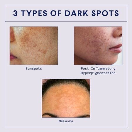 Hyperpigmentation can happen for a number of reasons: acne, sun exposure, and pregnancy-related hormonal changes, to name a few. Learn how to identify and treat hyperpigmentation from the dermatology experts at Curology. Treat Hyperpigmentation, Skin Care Pictures, Facial Anatomy, Treating Hyperpigmentation, Face Tips, Dermatological Skin Care, Skin Care Clinic, Acne Spots, Fade Dark Spots