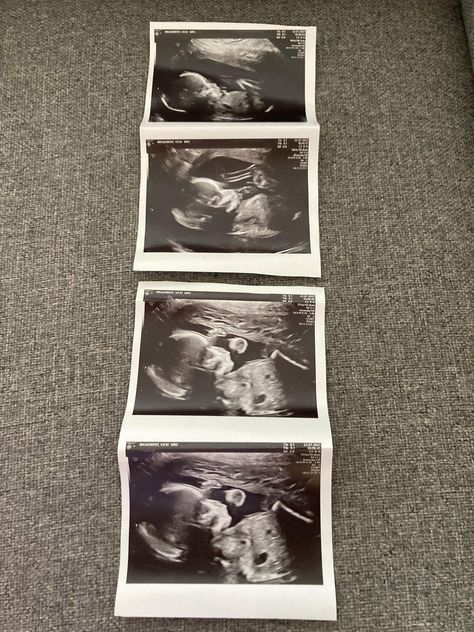 20 week scan pics 5 Months Pregnant Ultrasound, 20 Week Ultrasound Pictures, 20 Week Pregnancy Photos, 20 Week Pregnancy, 20 Week Ultrasound, Fake Ultrasound, Pregnant Pics, Baby Ultrasound Pictures, Pregnancy Scan