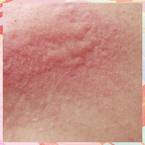 Suffer from itchy skin? This is everything you need to know about dermatitis straight from an expert Skin Allergy Pictures, Contact Dermitis Rash, Skin Rash Remedies, Skin Rashes Pictures, Common Skin Rashes, Itchy Skin Rash, Itchy Skin Remedy, Rash On Face, Remedies For Skin