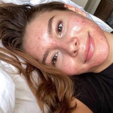 @olivia_wears_prada on Instagram: “learning self love 💗” Acne Self Love, Acne Is Beautiful, Normalize Acne, Celebrities With Acne, Acne Appreciation, Strawberry Freckles, Learning Self Love, Acne Aesthetic, Imperfect Skin