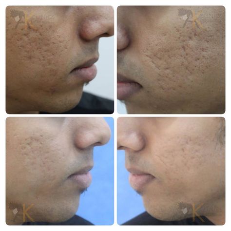 Microneedling Before And After, Laser Acne Scar Removal, Before And After Acne, Acne Scar Remedies, Scar Remedies, Acne Scar Mask, Esthetician Marketing, Severe Acne, Acne Scar