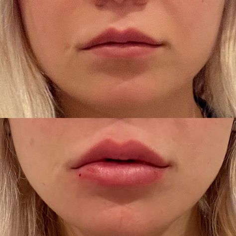 Are you ready to have a lip filler with natural-looking results? Try our Restylane Silk Filler, it's an FDA-approved filler which enhances the shape and volume of the lips, as well as reduce fine lines above the mouth, often referred to as smoker's lines. 💬 or ☎️ (954) 763-2998 📍 1211 E Broward Blvd, Fort Lauderdale, FL 33301 #2022 #antiaging #southflorida #fortlauderdale #ftlauderdale #lasolas #lasertreatments #skincare #botox #dysport #kysse #contour #kybella #lips #lusciouslips Heart Shaped Face, Smokers Lines, Heart Shaped Lips, Lip Filler, Healthy Routine, Heart Face Shape, Lip Fillers, Fort Lauderdale, Fort