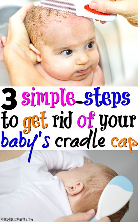 Simple steps to get rid of your baby's cradle cap once and for all! Helpful and very effective tips you have to read! via @http://www.pinterest.com/stressfreemom Cradle Cap Remedies, Baby Cradle Cap, Cradle Cap, Awesome Mom, Baby Kicking, Pumping Moms, Baby Cradle, Baby Sleep Problems, Learning Strategies