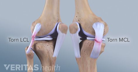 Lateral collateral ligament (LCL) tears are often seen in sports such as football and hockey, and are usually the result of a direct blow to the knee or quickly changing direction on one foot. Mcl Tear Symptoms, Mcl Tear, Sprained Knee, Knee Dislocation, Mcl Injury, Meniscal Tear, Knee Ligaments, Anterior Cruciate Ligament, Ligament Tear