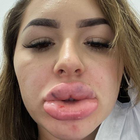 Bad Lip Injections, Swollen Lips, Anna Paul, Plastic Surgery Fail, Botox Lips, Fake Lips, Grills Teeth, Tiktok Star, Human Anatomy And Physiology