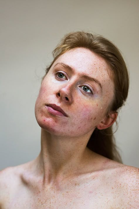 Sophie Harris-Taylor breaks down the stigmas of skin issues with photo series Epidermis Acne Positivity, Skin Positivity, Raw Photography, Severe Acne, Women Skin, Face Photography, Raw Beauty, Photo Series, Skin Issues