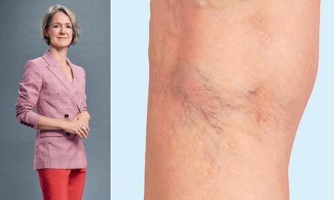 How can I banish thread veins before my holiday? | Daily Mail Online Veins Exercise, Thread Veins, They Said, Weights Workout, Daily Mail, How Can, Cider, I Can, Thread